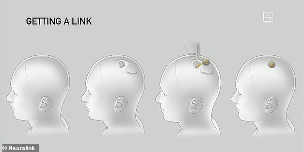 A schematic drawing shows how Neuralink would implant a chip into a head with minimal invasion